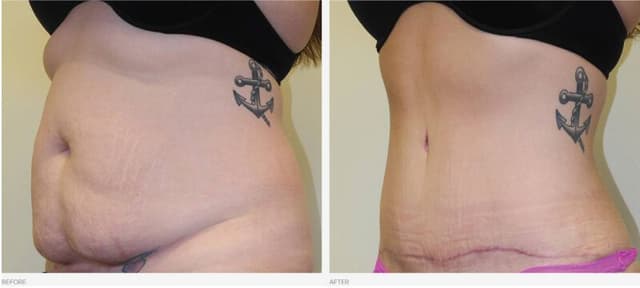 Tummy Tuck (Abdominoplasty) procedure image
