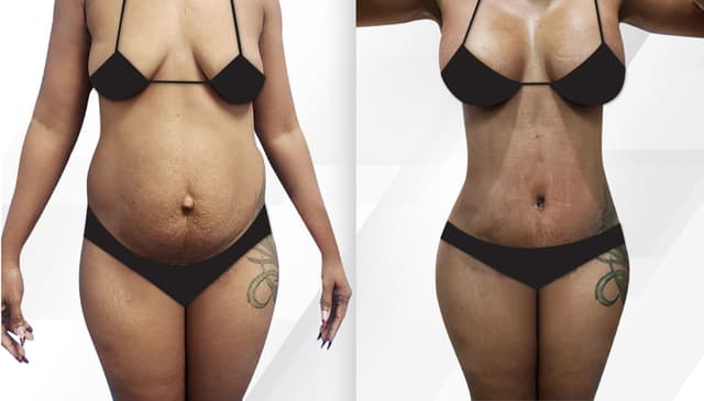 Mommy Makeover procedure image