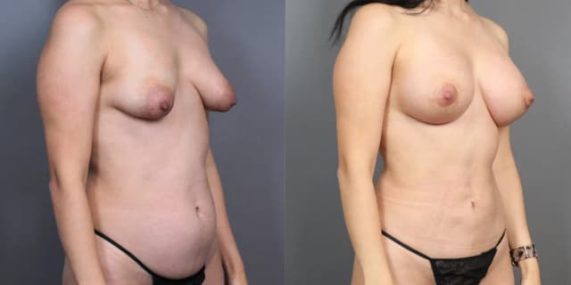 Breast Augmentation procedure image