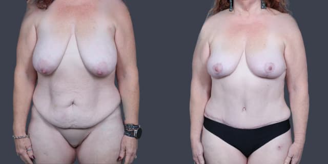 Mommy Makeover procedure image