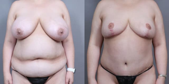 Tummy Tuck (Abdominoplasty) procedure image