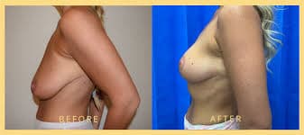 Breast Augmentation procedure image