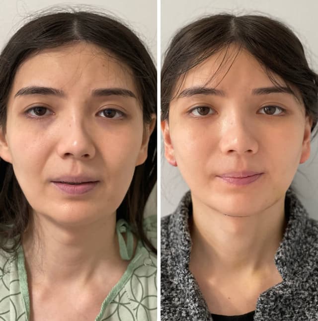 Facelift procedure image