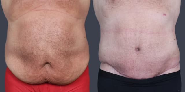 Tummy Tuck (Abdominoplasty) procedure image