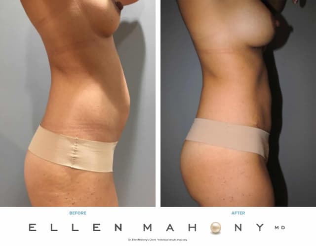 Mommy Makeover procedure image