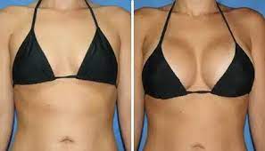 Breast Augmentation procedure image