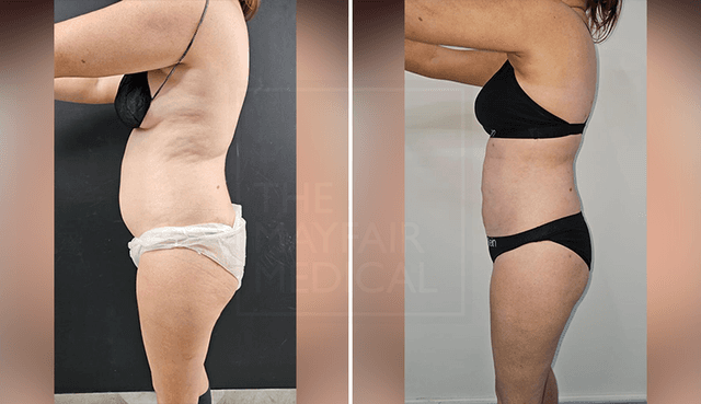 Liposuction procedure image