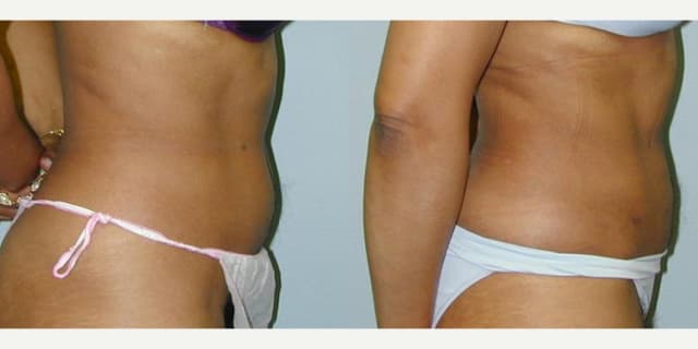Liposuction procedure image