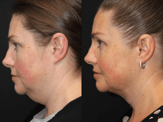 Neck Lift procedure image