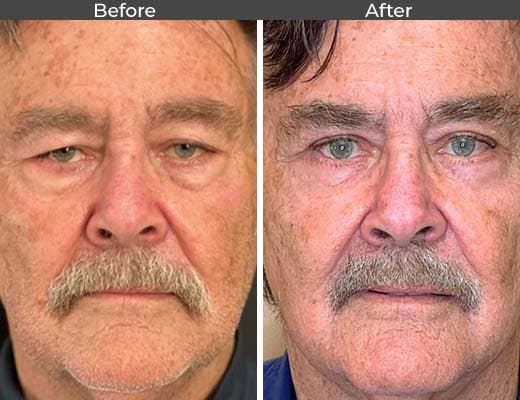 Eyelid Surgery (Blepharoplasty) procedure image