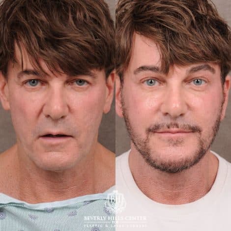 Facelift procedure image