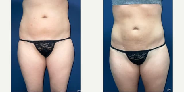 Liposuction procedure image