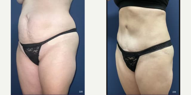 Tummy Tuck (Abdominoplasty) procedure image