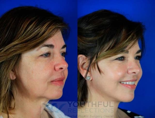 Facelift procedure image