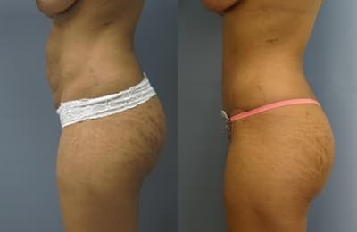 Liposuction procedure image