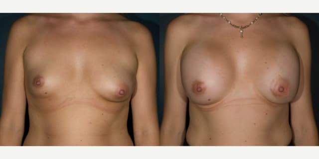 Breast Augmentation procedure image