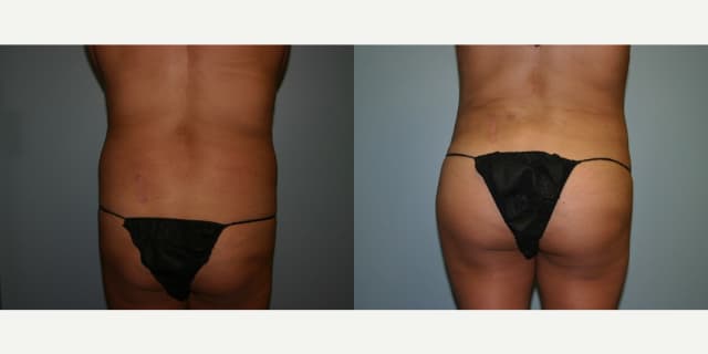 Brazilian Butt Lift (BBL) procedure image