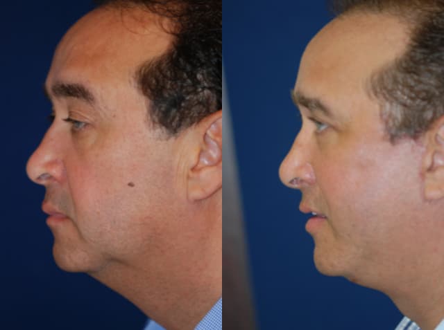 Facelift procedure image
