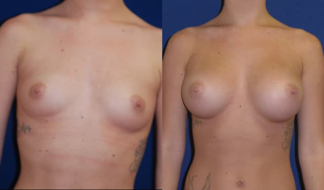 Rhinoplasty (Nose Job) procedure image