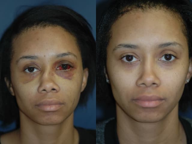 Breast Augmentation procedure image