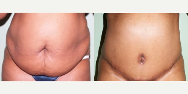 Tummy Tuck (Abdominoplasty) procedure image