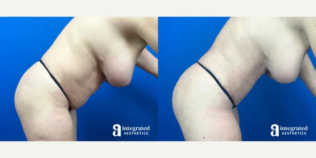 Tummy Tuck (Abdominoplasty) procedure image