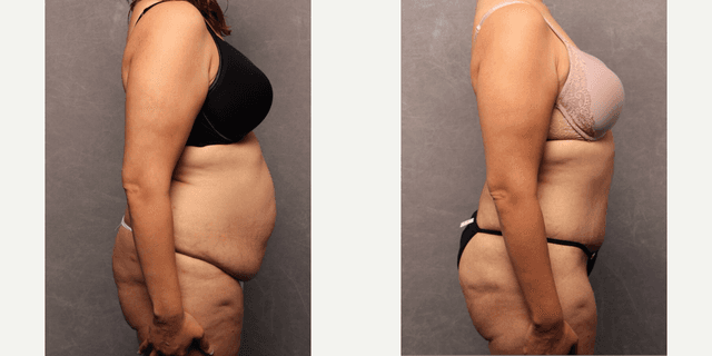 Tummy Tuck (Abdominoplasty) procedure image