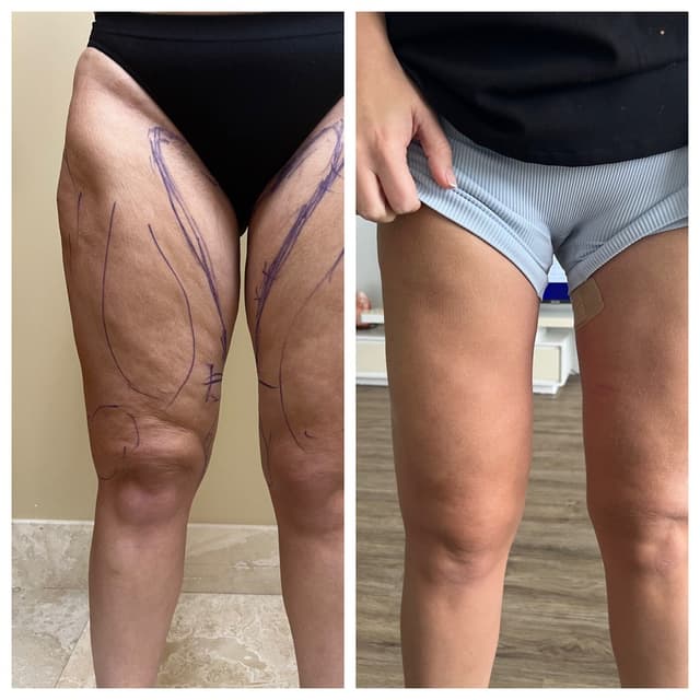 Thigh Lift procedure image