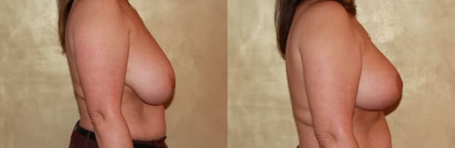 Breast Lift (Mastopexy) procedure image