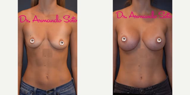 Breast Augmentation procedure image