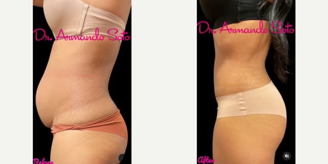Tummy Tuck (Abdominoplasty) procedure image