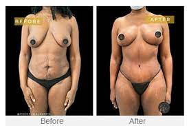 Mommy Makeover procedure image