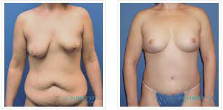 Breast Lift (Mastopexy) procedure image