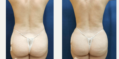 Skin Tightening procedure image