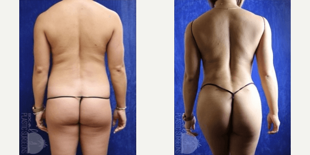 Brazilian Butt Lift (BBL) procedure image