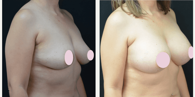 Breast Augmentation procedure image