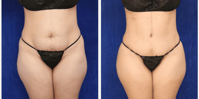 Liposuction procedure image