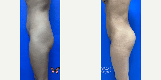 Brazilian Butt Lift (BBL) procedure image