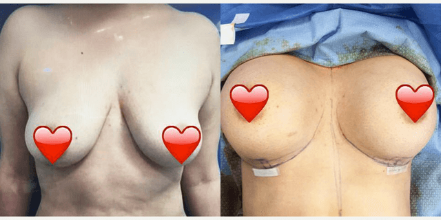 Breast Augmentation procedure image