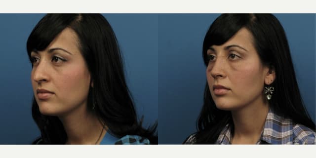 Rhinoplasty (Nose Job) procedure image
