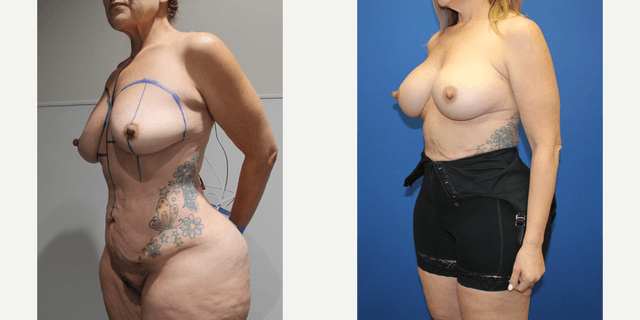 Breast Augmentation procedure image