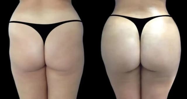 Hip Enhancement procedure image