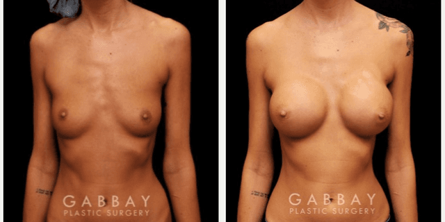 Mommy Makeover procedure image