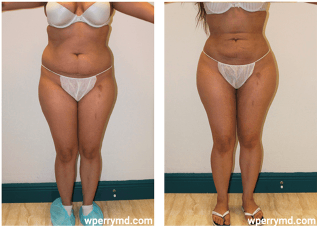 Body Lift procedure image