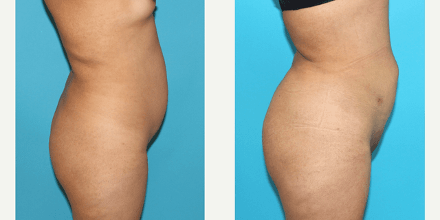 Hip Enhancement procedure image