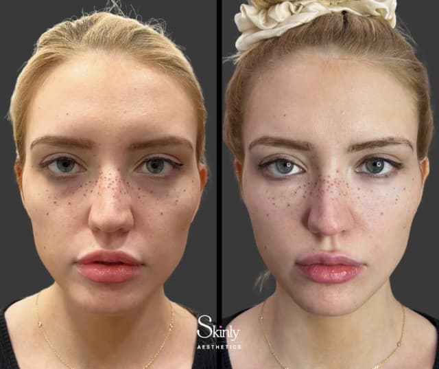 Cheek Enhancement procedure image