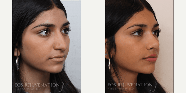 Rhinoplasty (Nose Job) procedure image
