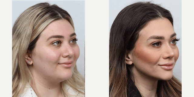 Fillers & Injectables (e.g. Botox, Juvederm) procedure image