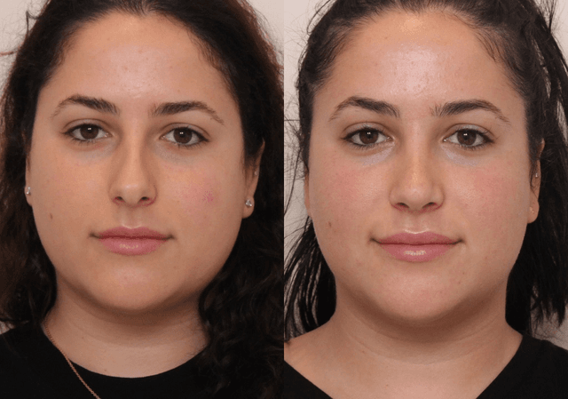 Cheek Enhancement procedure image