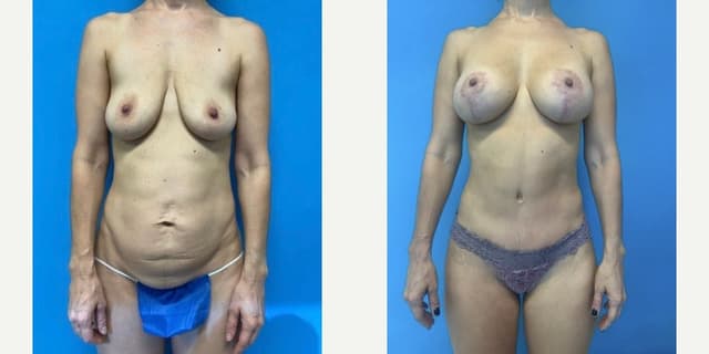 Breast Augmentation procedure image